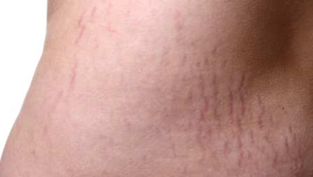 What are stretch marks?